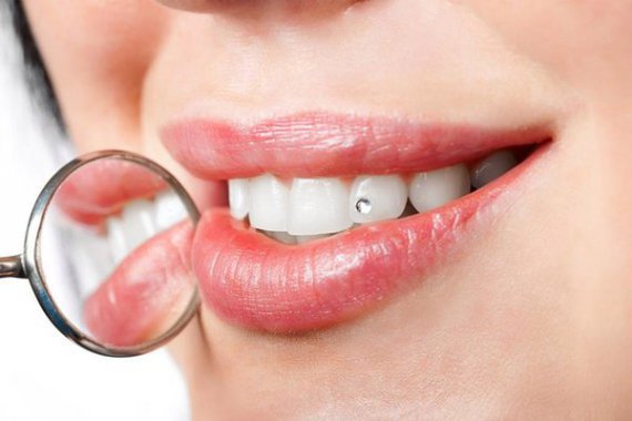 Имплантация зубов: отчего зависит успех имплантации? Что является самым важным? 