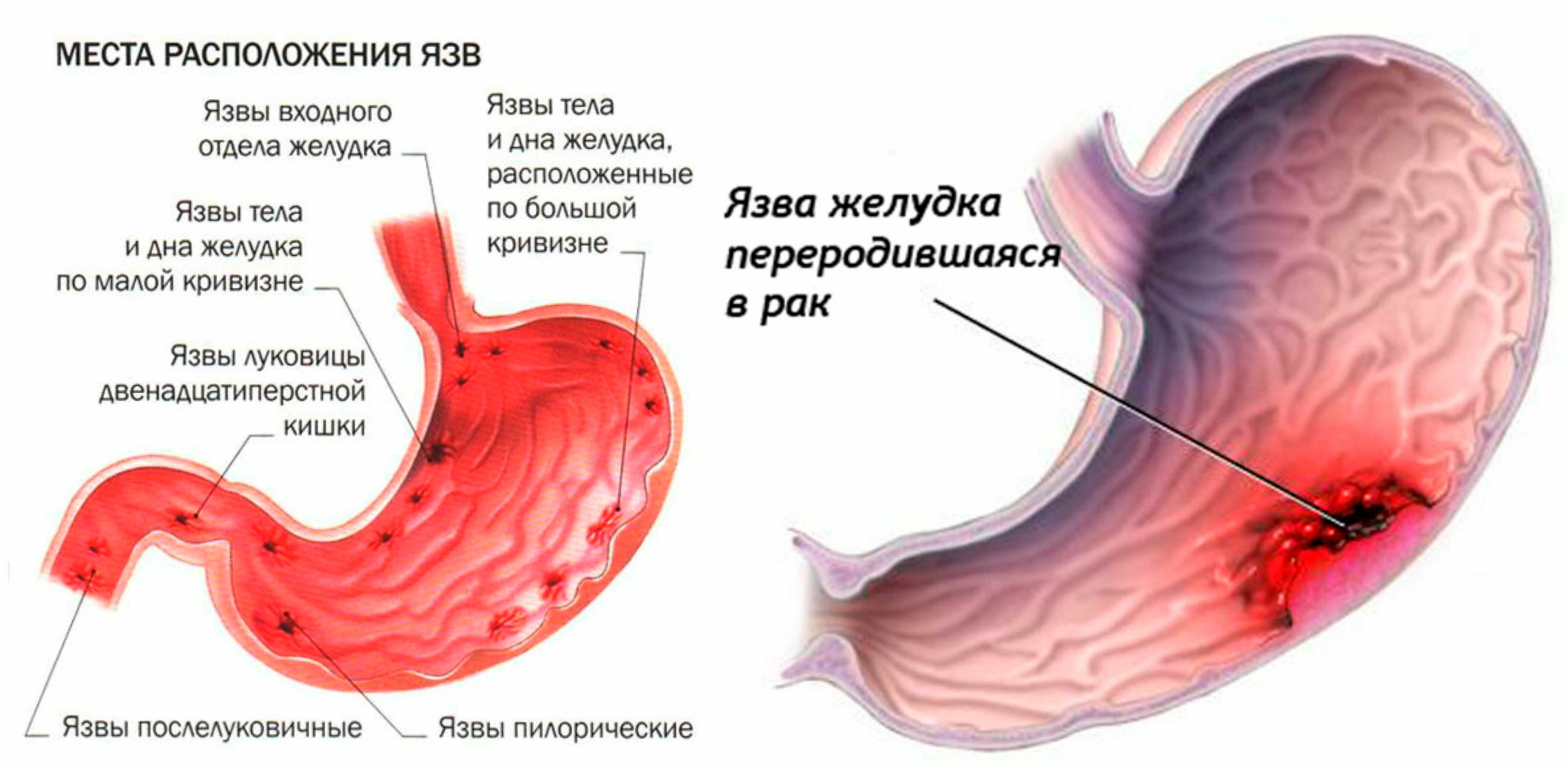 Почему стоит желудок. Язвенная болезнь желудка симптомы. Язвенная болезнь желудка и 12-перстной кишки. Гастрит. Язвенная болезнь малой кривизны желудка. Расположение язв в желудке.